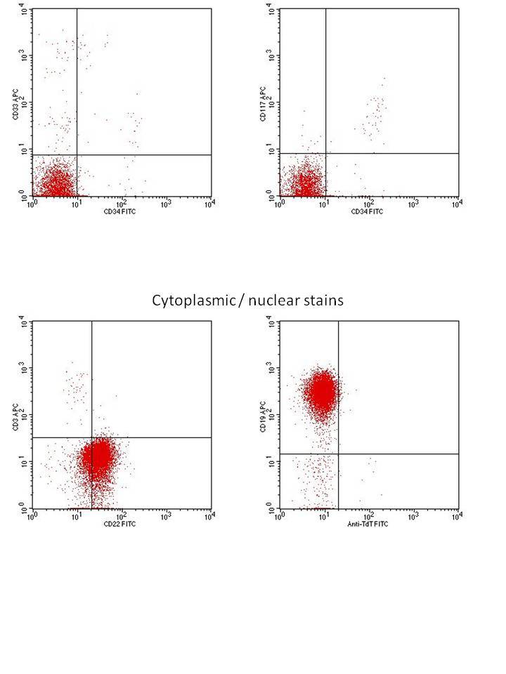 Flow cytometry from blood:  Tumor cells are positive for CD19 and cCD22, but negative for TdT, CD34, CD117, and cCD3.