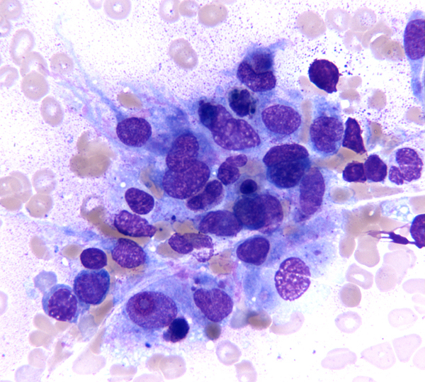Bone marrow aspirate smear (8 months post T-ALL diagnosis), a cluster of atypical histiocytic cells.