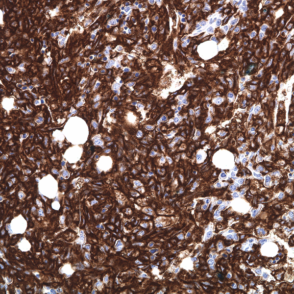 Bone marrow biopsy 8 months after T-ALL diagnosis, CD14.