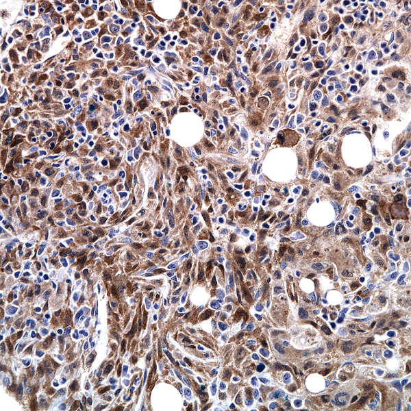 Bone marrow biopsy 8 months after T-ALL diagnosis, Factor 13a.