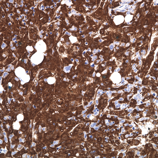 Bone marrow biopsy 8 months after T-ALL diagnosis, fascin.