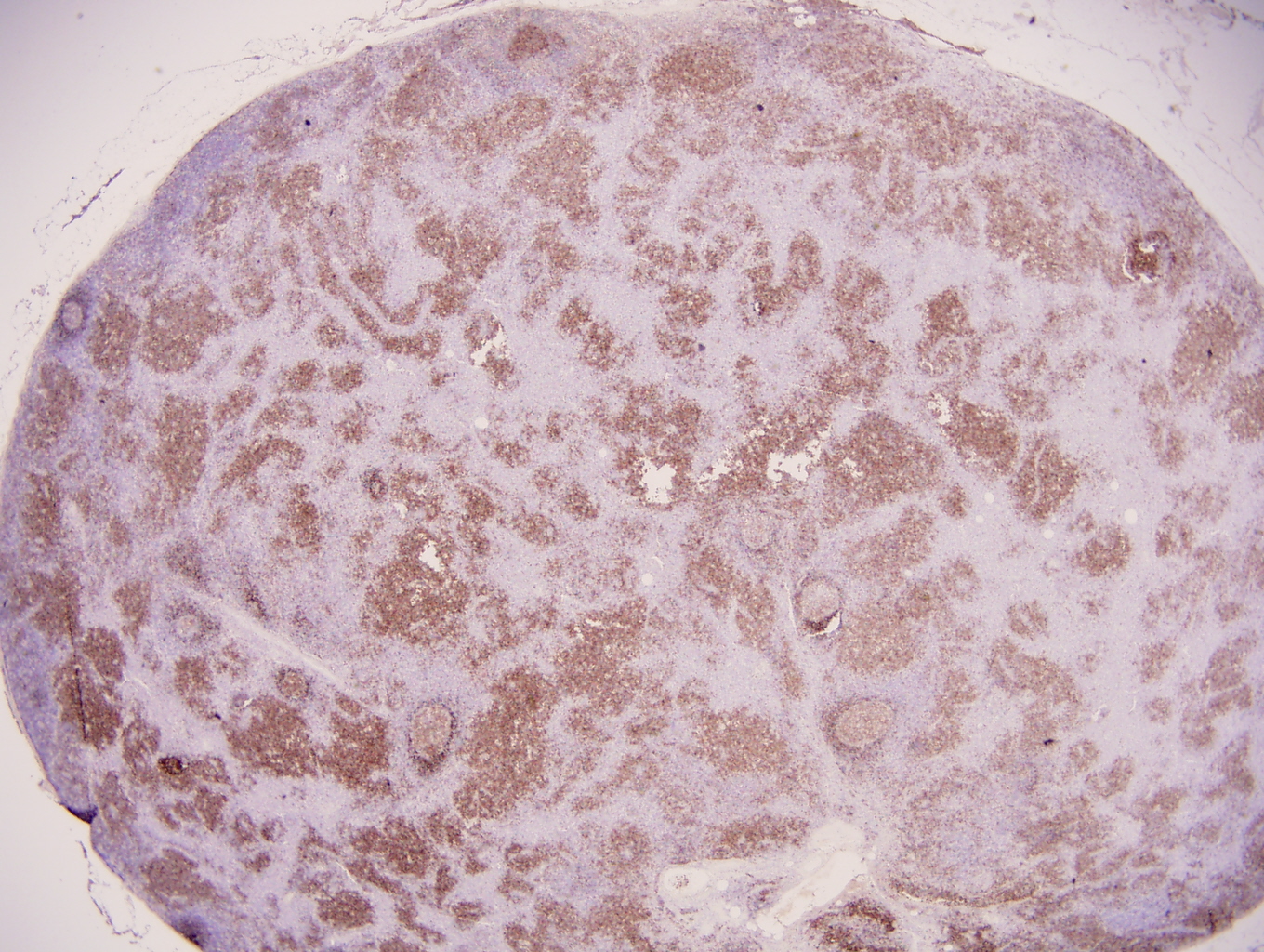Additional figure 1: TCL1 IHC, 20x