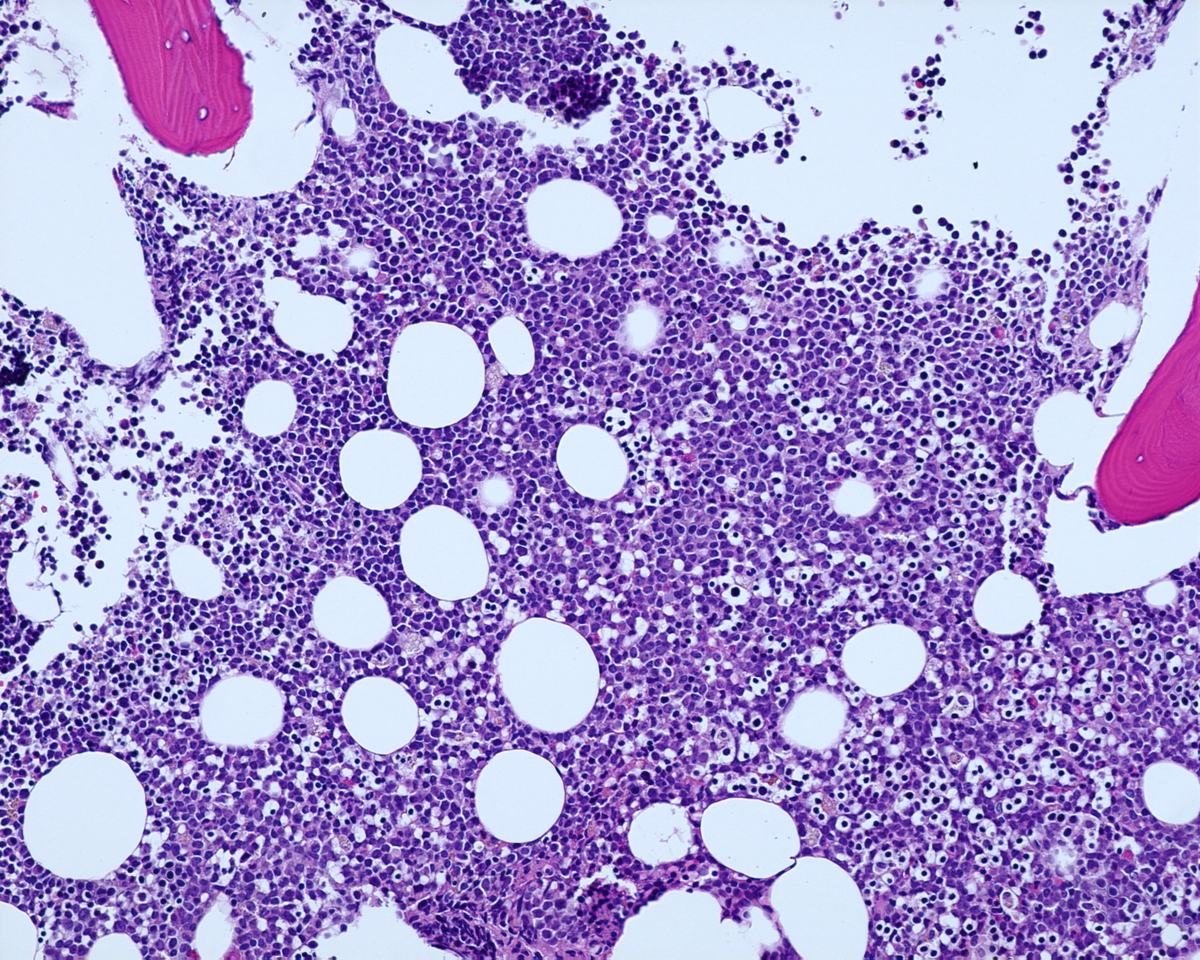 Bone marrow biopsy with a hypercellular bone marrow and increse in blasts.