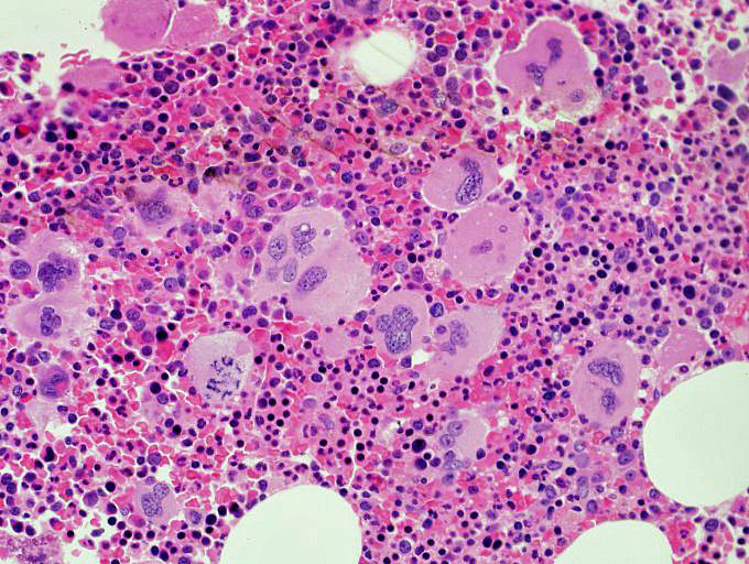 H&E-stained bone marrow core biopsy from 1996