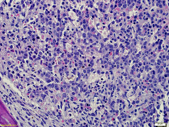 H&E-stained bone marrow trephine biopsy showing increased interstitial blasts and peri-trabecular aggregate of spindled mast cells