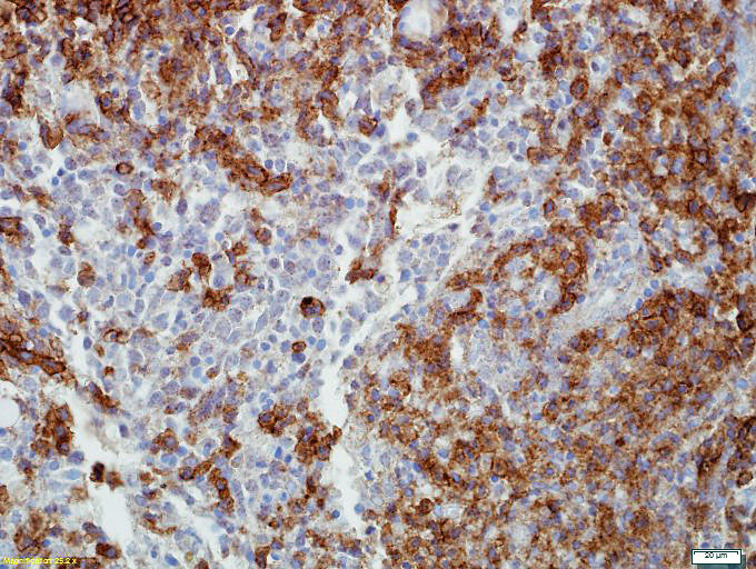 Immunohistochemical stain for CD25 demonstrates aberrant co-expression of this antigen by mast cells