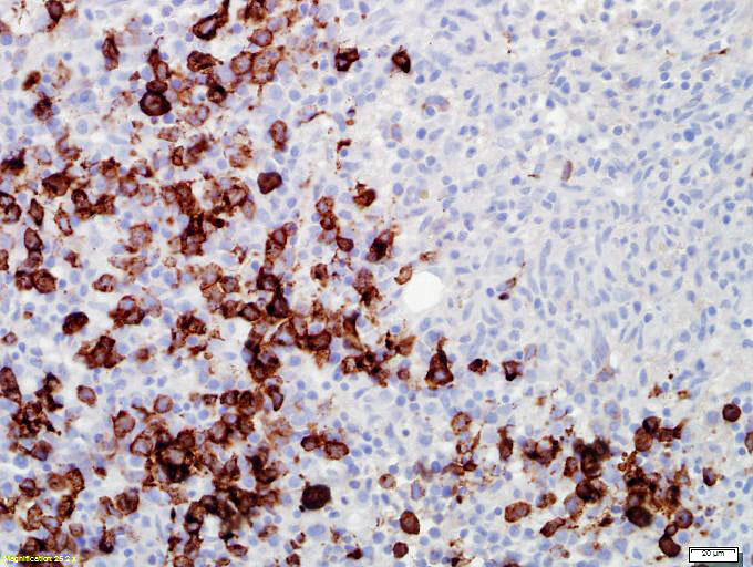 Immunohistochemical stain highlighting increased CD34+ blasts adjacent to a large aggregate of mast cells