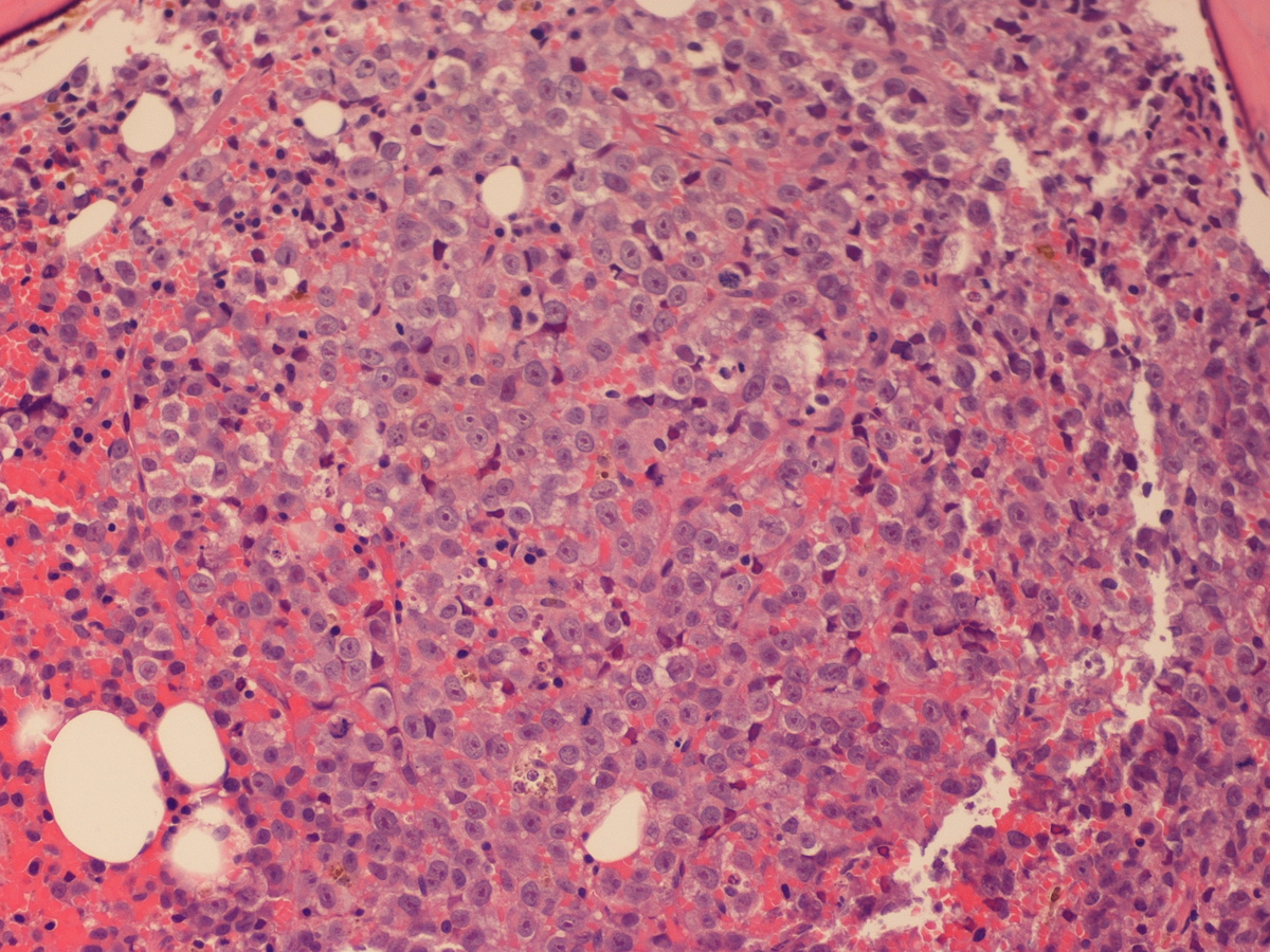Marrow replaced by malignant erythroblasts (after 33 day trial of decitabine)