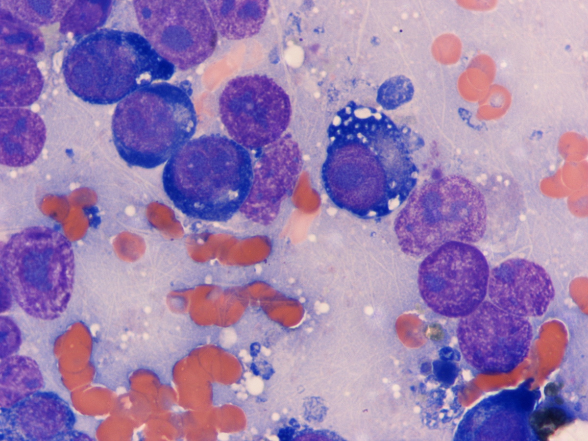 Eryrthroblasts in bone marrow aspirate (1000X)