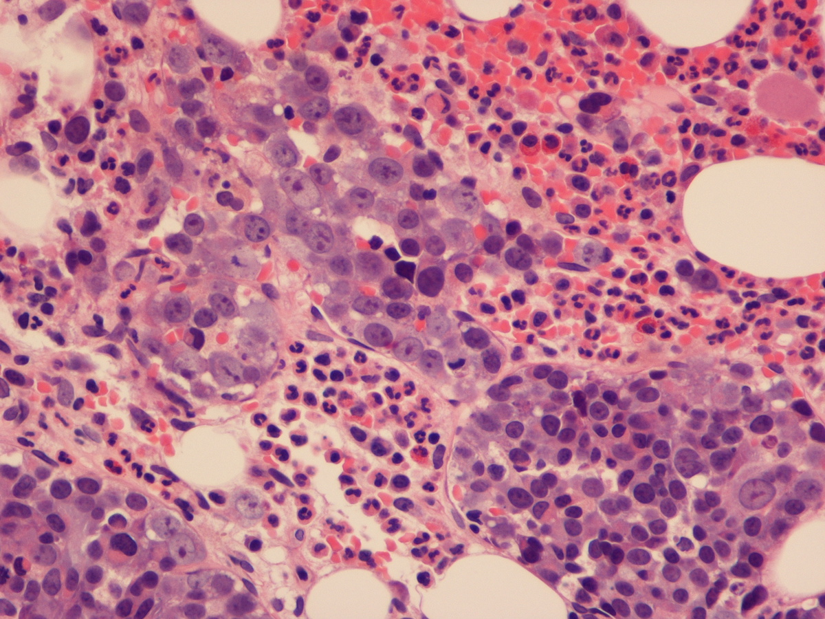 Malignant erythroblasts showing intrasinusoidal distribution (400X)