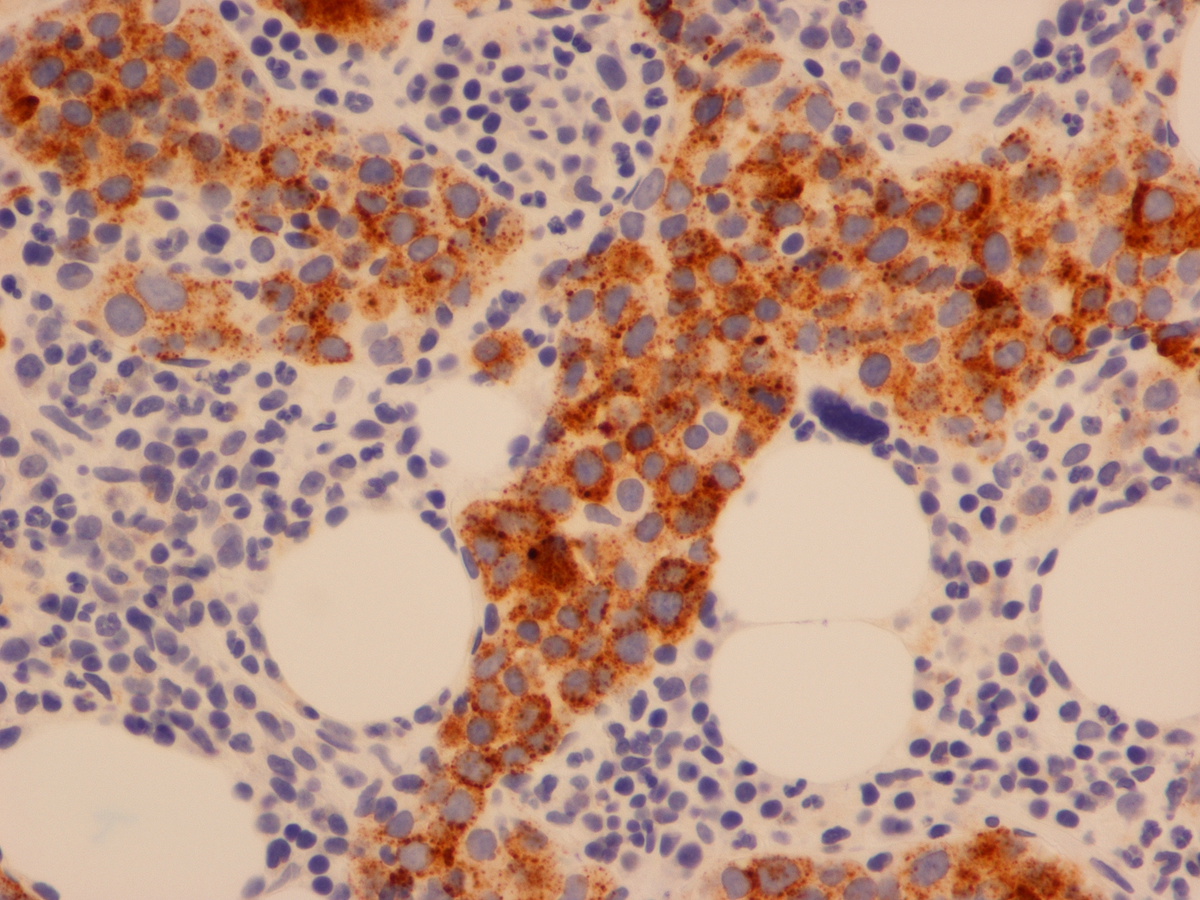 CD71 stain highlights malignant erythroblasts