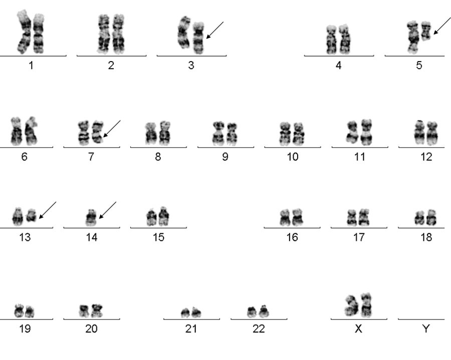 Chromosome analysis revealed inv (3) (p21q26), del (5) (q13q33), del (7) (q22q34), del(13) (q13q22), and -14 in 16/20 metaphase cells