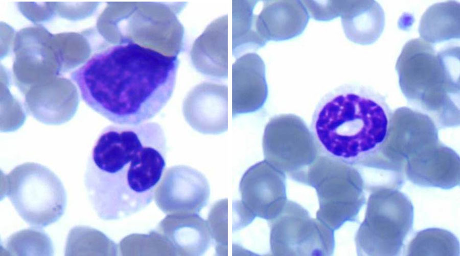 Dysplastic neutrophils on the peripheral blood smear