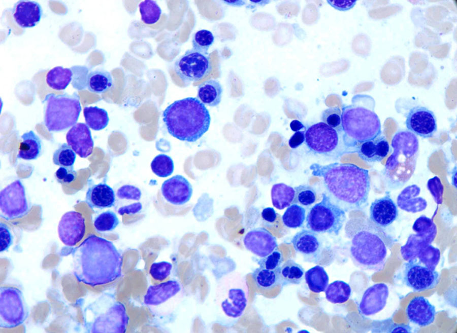 Representative morphologic features from bone marrow aspirate smears (100X). Erythroid precursors show megaloblastoid changes, nuclear budding, nuclear irregularity, and nuclear bridging. Myeloid precursors show dysplastic features including hypogranulation and hyposegmentation.