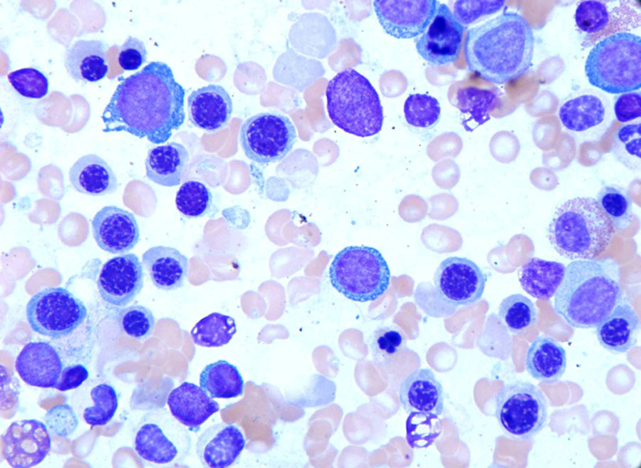 Representative morphologic features from bone marrow aspirate smears (100X). Erythroid precursors show megaloblastoid changes and nuclear budding.