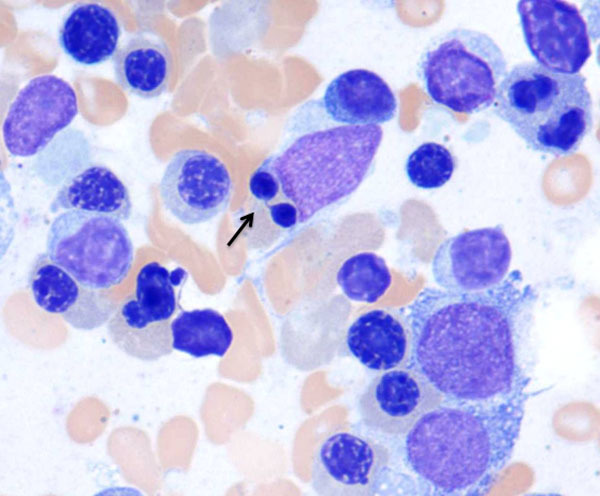 Representative morphologic features from bone marrow aspirate smears (100X). Nuclear bridging is clearly visible in this picture (arrow).