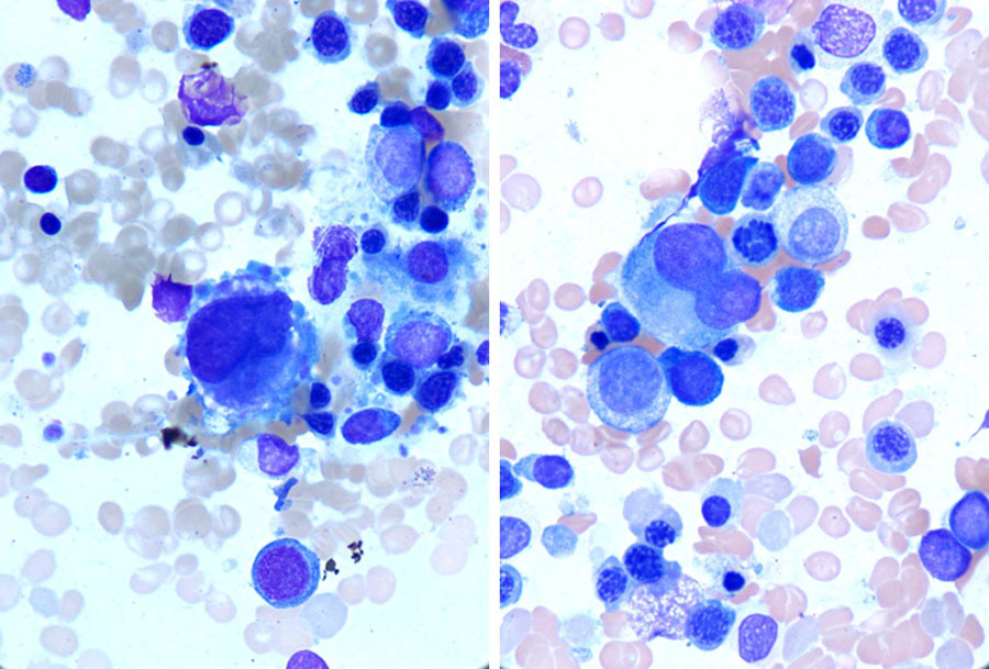 Representative morphologic features from aspirate smears (100X). Megakaryocytes are small and hypolobated or monolobated.