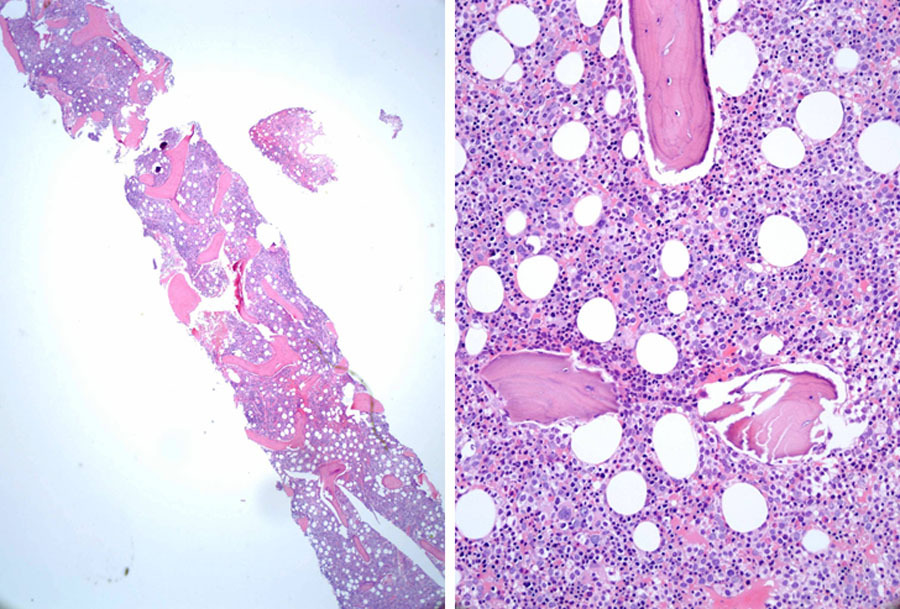 The core biopsy shows hypercellular marrow with erythroid hyperplasia, left-shifted myeloid population and atypical megakaryocytes