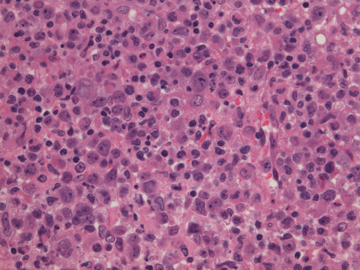 Clot section H&E