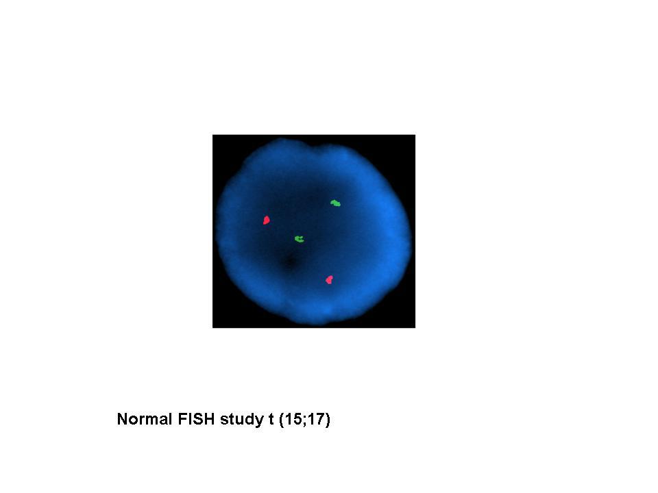 2010: FISH t( 15;17): Negative study