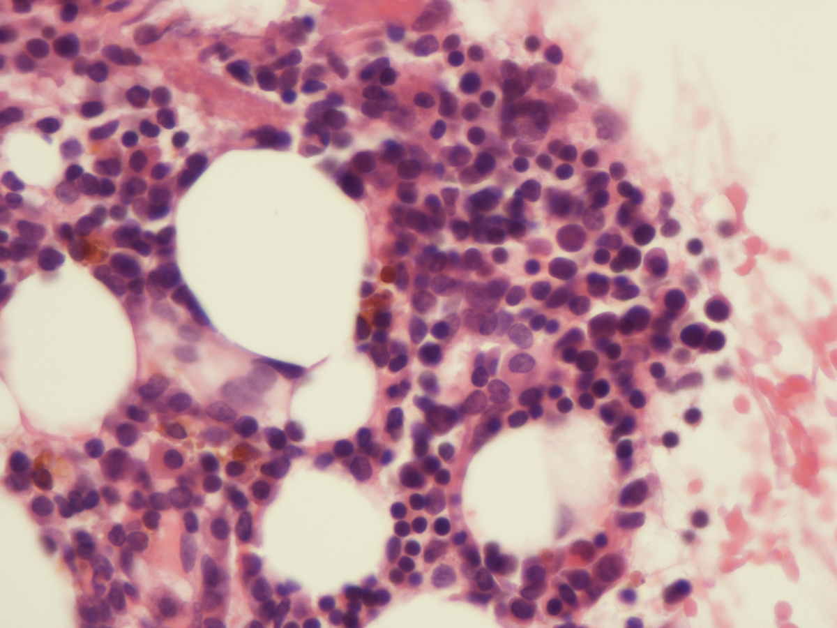 Bone marrow biopsy is normocellular for patient
