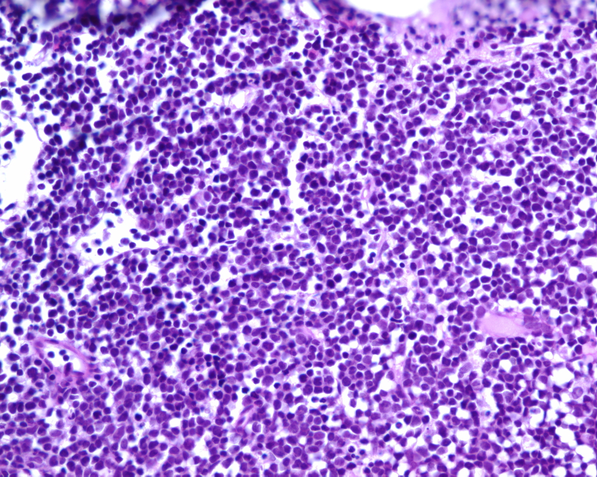 Bone marrow biopsy with a hypercellular bone marrow and increase in blasts.