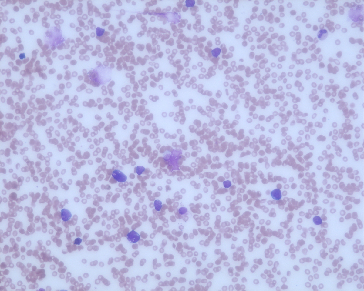 Bone marrow aspirate smear with increased blasts.