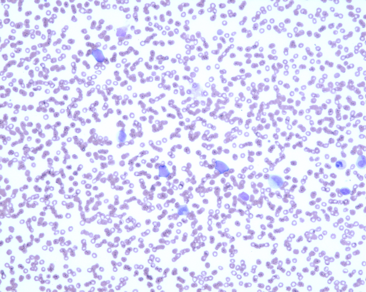 Peripheral smear showing blasts.