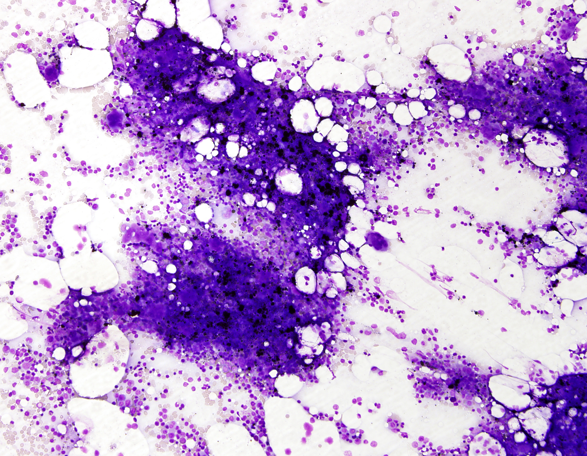 Bone marrow aspirate, low power, WG stain, showing hypercellular particles