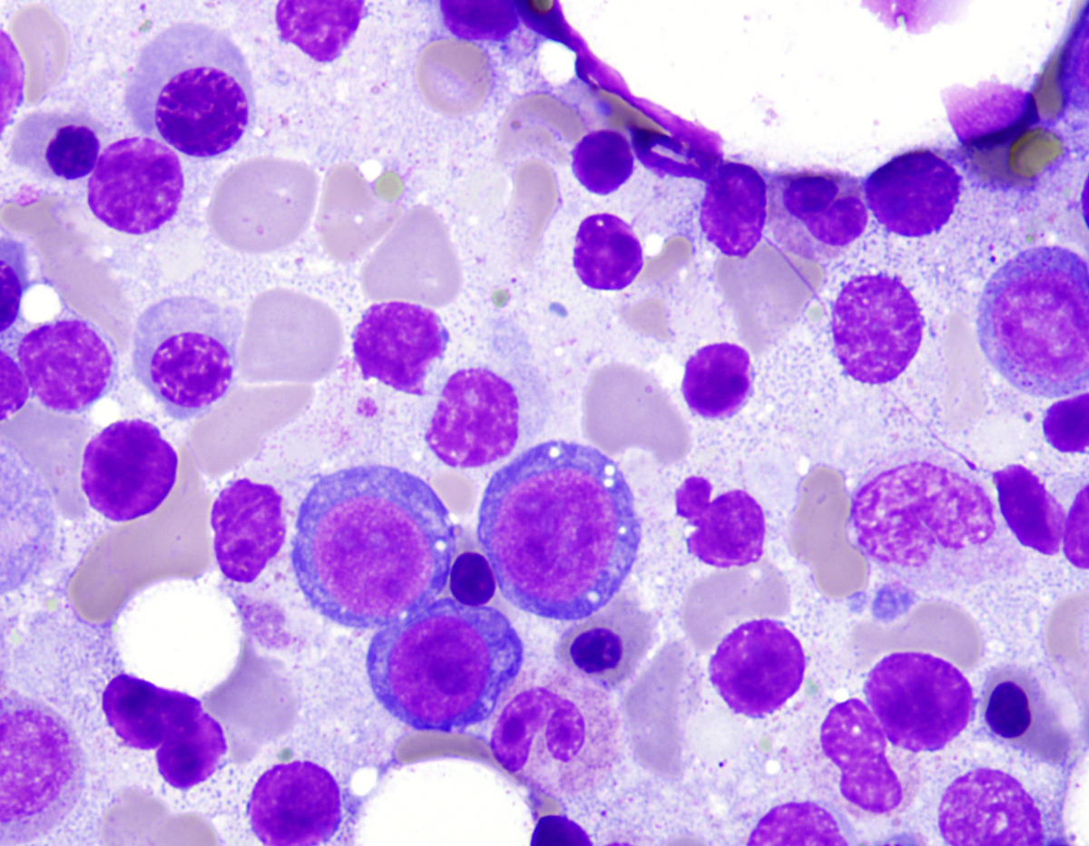 Higher power, bone marrow aspirate showing megaloblastoid change of erythroid precursors, with some vacuolization of erythroid percursors