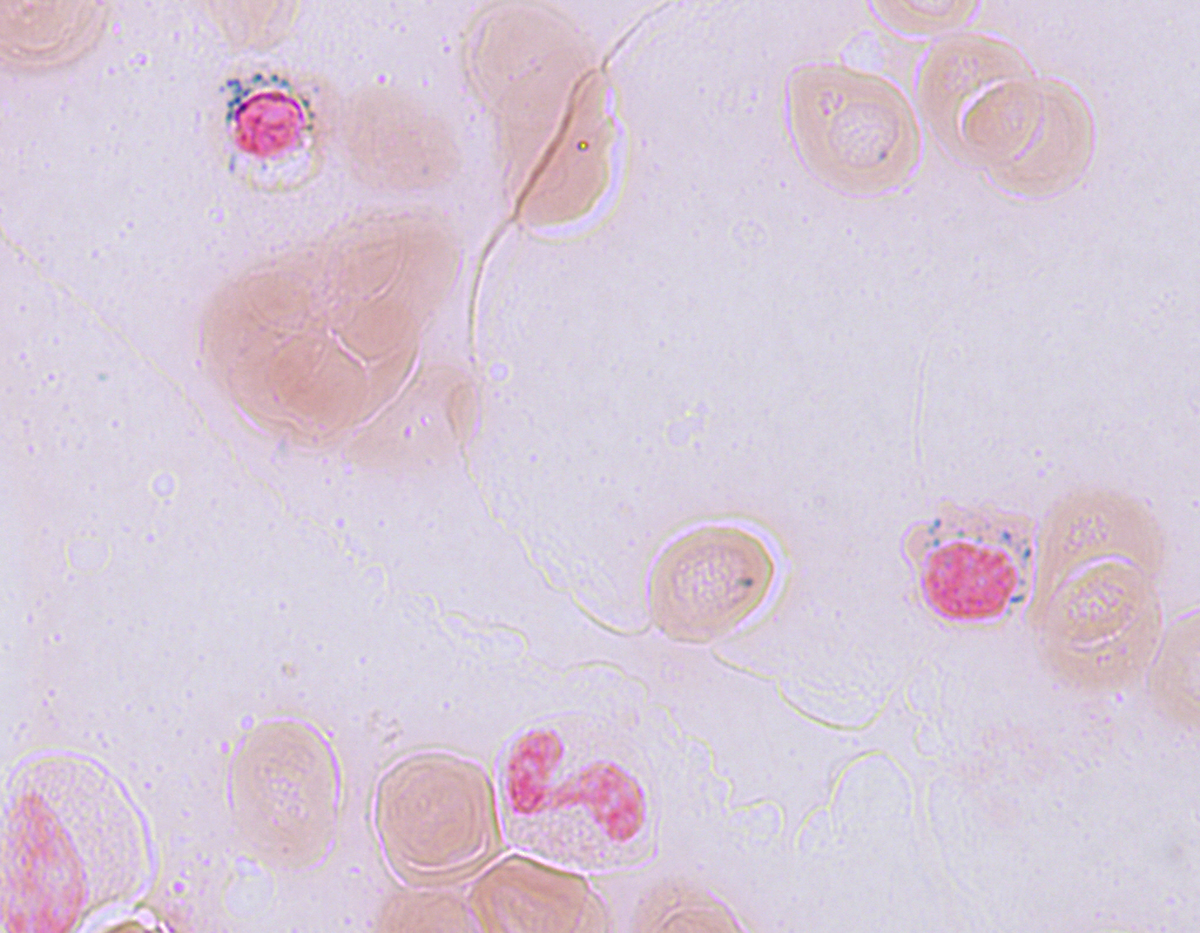 Prussian blue stain, ring sideroblasts