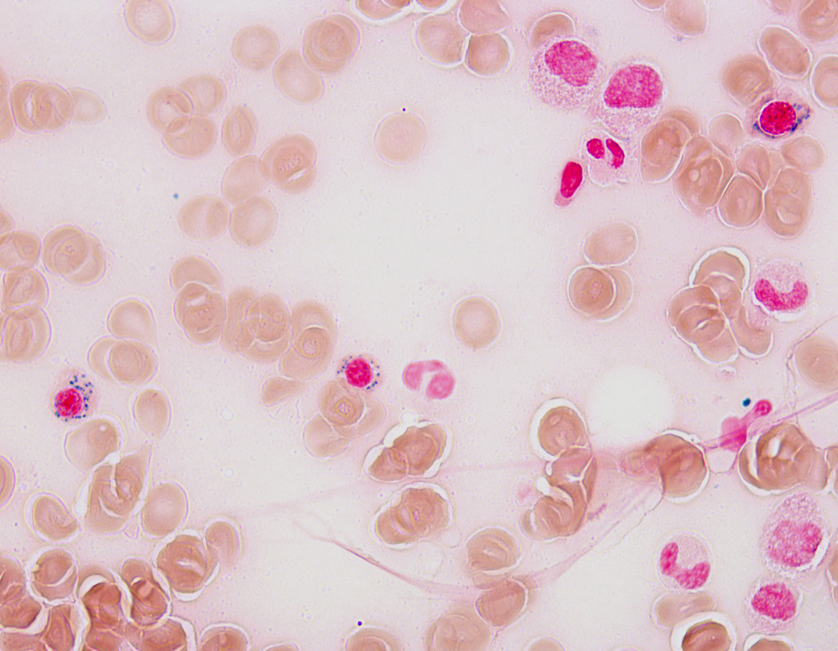 Prussian blue stain, ring sideroblasts