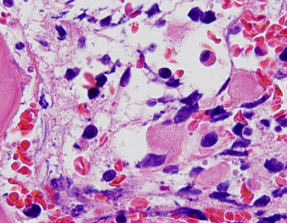 Similar dysplastic megakaryocyte, upper right, with 2 masses without visible attached cytoplasm or nuclei, lower right