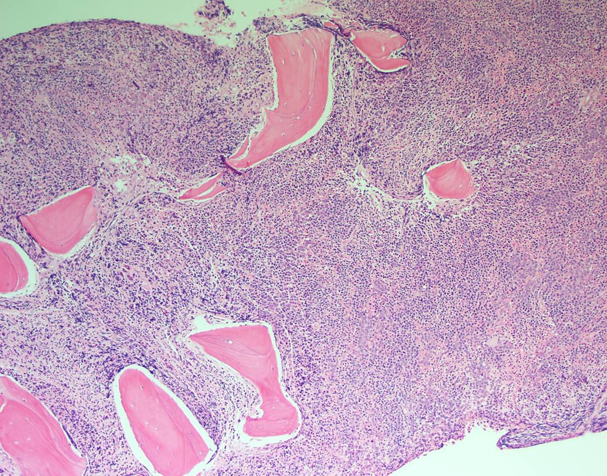 Bone marrow core biopsy, 10X