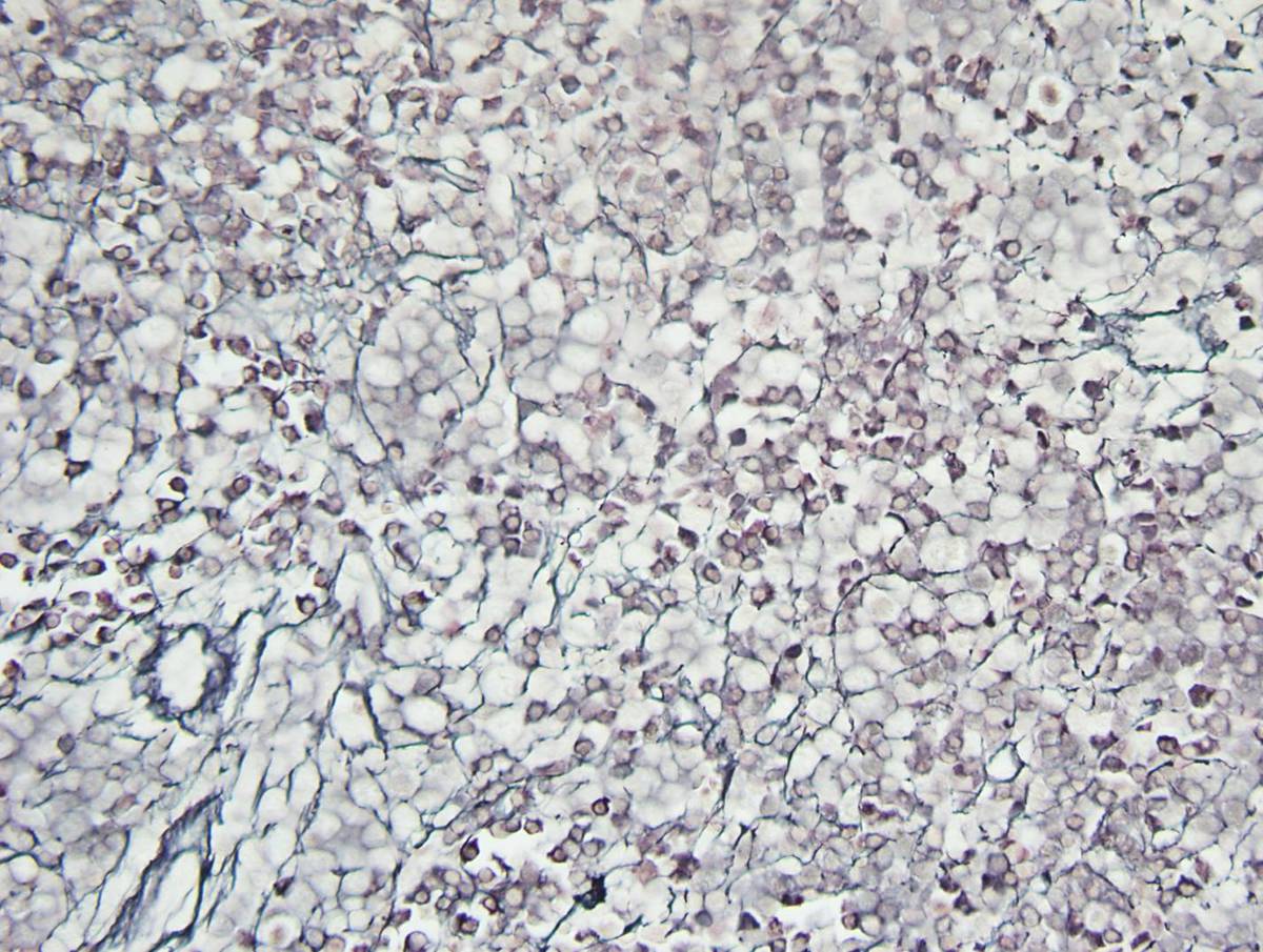 Bone marrow core biopsy, reticulin stain, 40X