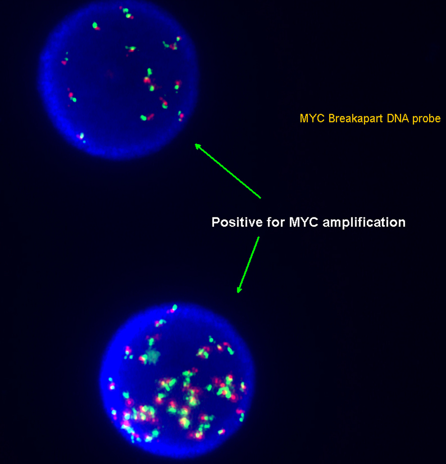 FISH for MYC showing amplification
