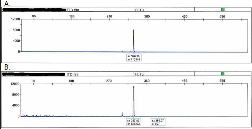 GeneScan results of FLT3 mutation status change in an acute myeloid leukemia patient