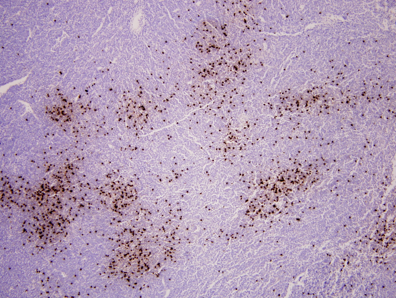 Additional figure 1: TCL1 IHC, 100x