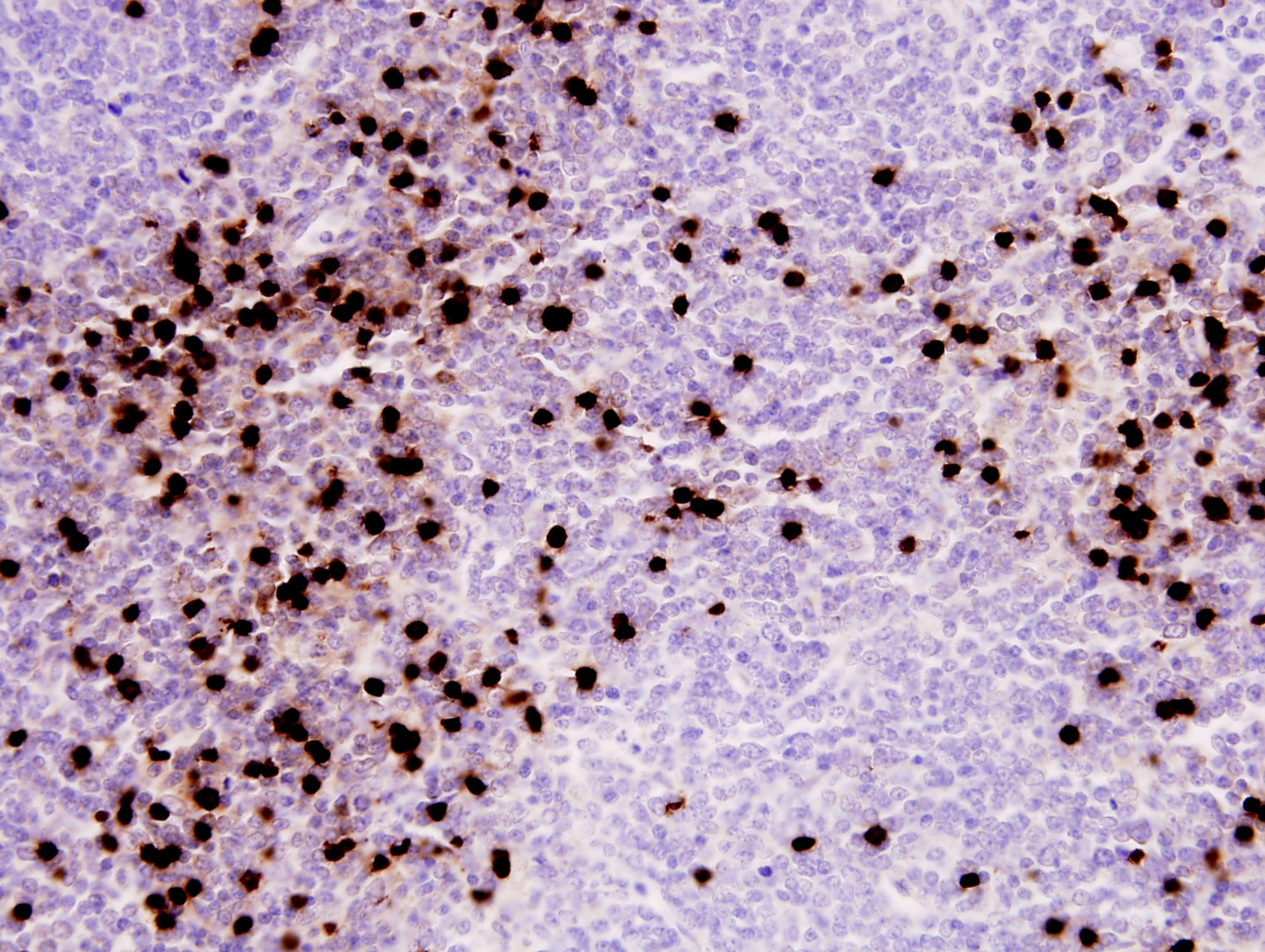 Additional figure 2: TCL1 IHC, 400x