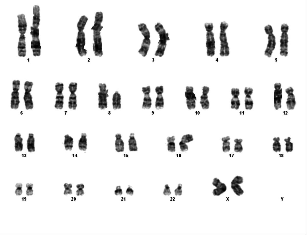 Conventional cytogenetics demonstrating a t(8;16)(p11.2;p13.3) in 17 of 20 metaphases analyzed