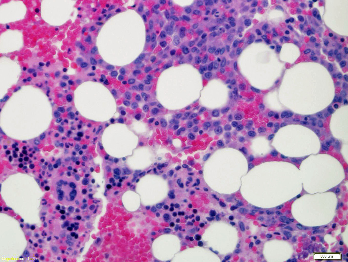 H&E-stained bone marrow core biopsy showing aggregates of blasts in a patchy ditribution