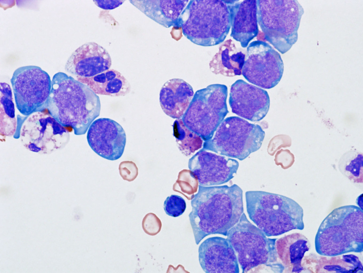 Cytospin preparation of bone marrow aspirate demonstrating increased blasts with monocytic features