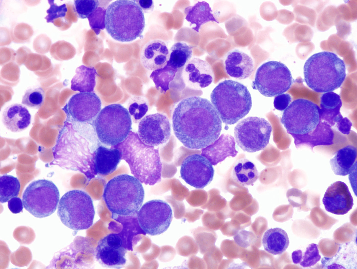Wright-stained bone marrow aspirate smear demonstrating increased blasts and residual maturing hematopoietic cells without significant dysplasia
