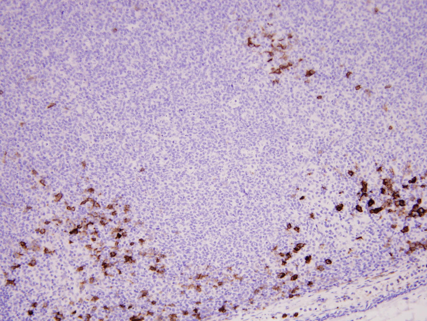 Additional figure 5: CD1a IHC, 200x