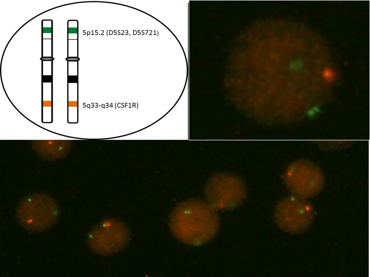 In a normal cell (upper left diagram), the expected FISH signal pattern is two orange probes (CSF1R) and two green probes (D5S23/D5S721). In a hybridized abnormal cell containing the 5q33-q34 deletion (upper right and below), the one orange, two green signal pattern is observed