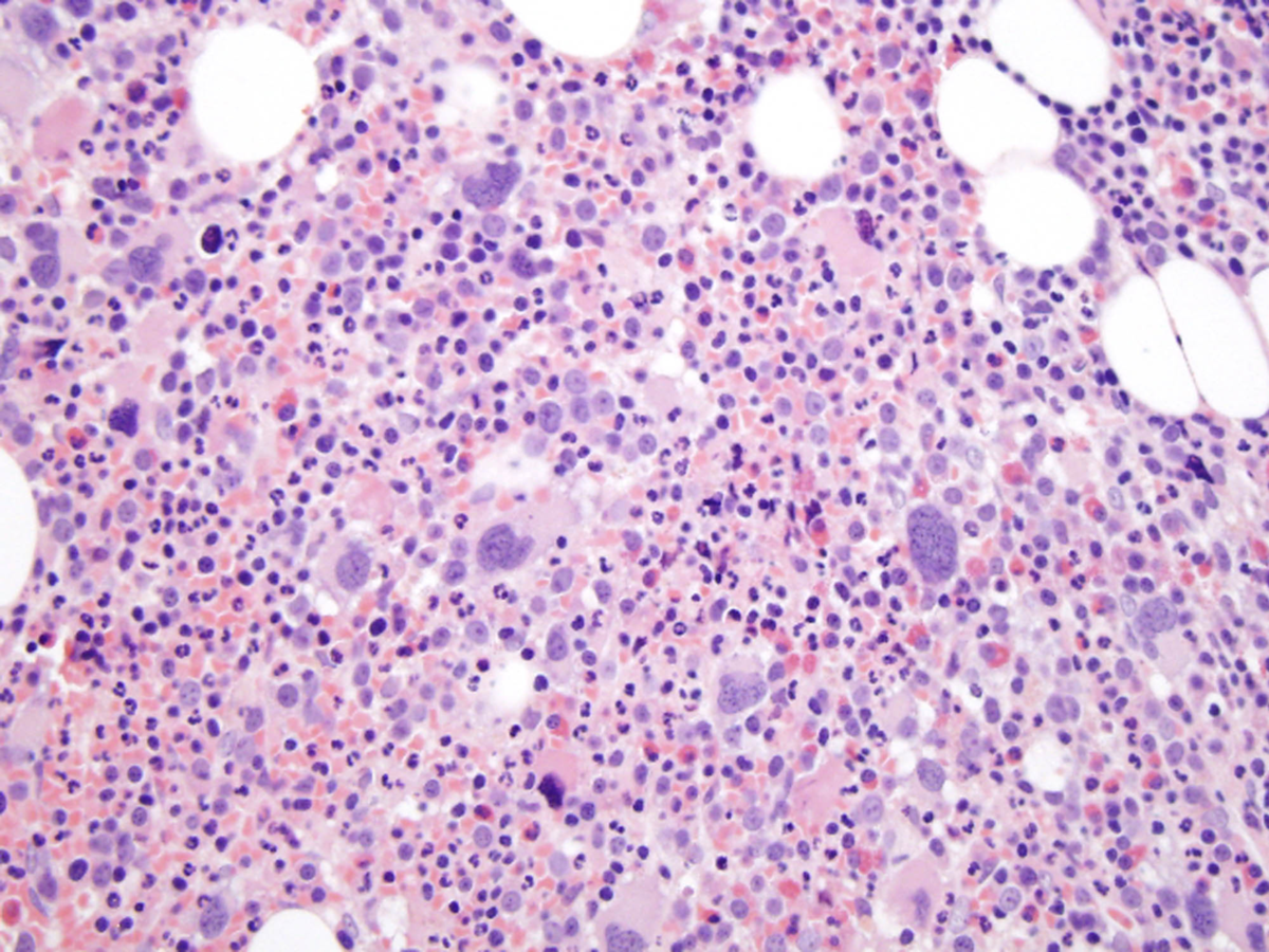 Hypercellular bone marrow core biopsy with increased megakaryopoiesis. Some megakaryocytes are large with hyperchromatic nuclei as well as occasional hypolobated nuclei