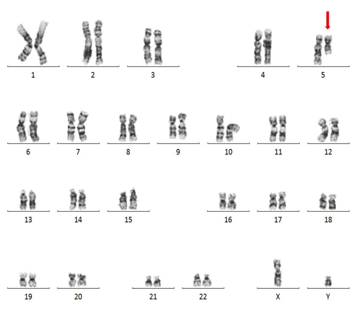 Representative karyogram at a 400 G-band resolution depicting an interstitial deletion of the long (q) arm of chromosome 5