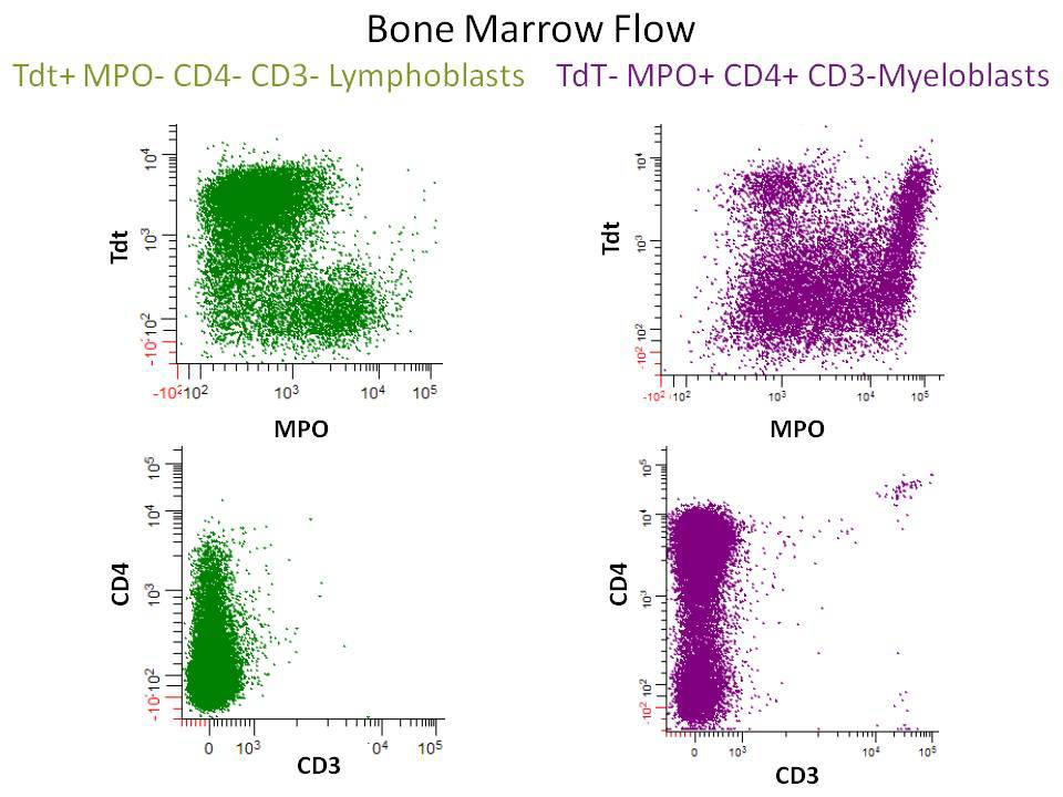 Bone marrow flow cytometry showing TdT+ MPO- CD4- CD3- lymphoblasts and TdT- MPO+ CD4+ CD3- myeloblasts