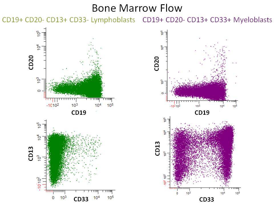 Bone marrow flow cytometry showing CD19+ CD20- CD13+ CD33- lymphoblasts and CD19+ CD20- CD13+ CD33+ myeloblasts