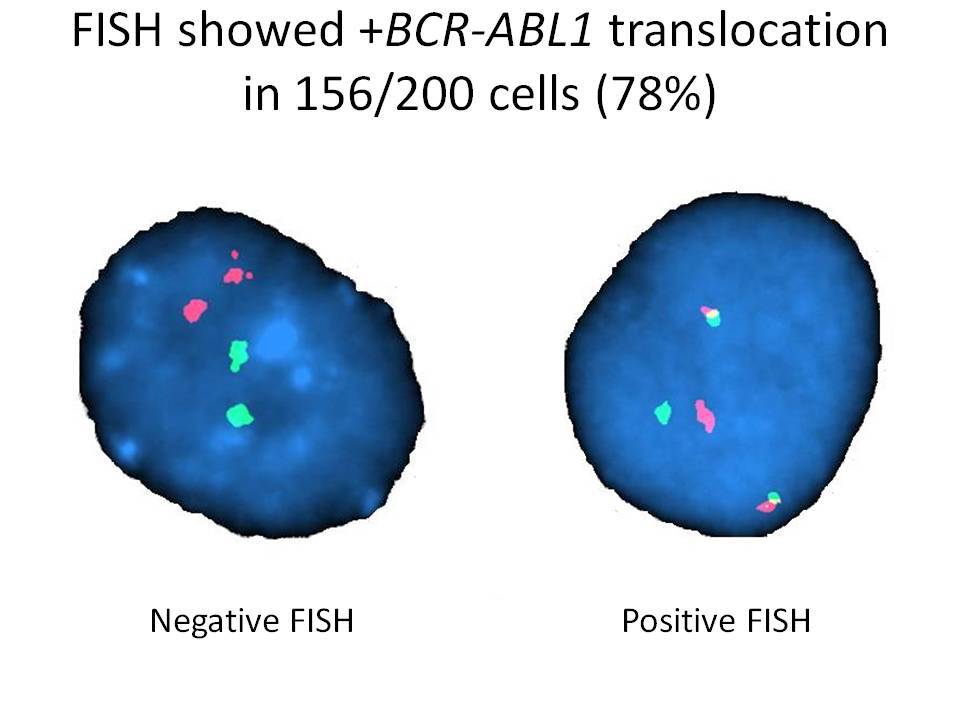 FISH shows a +BCR-ABL1 translocation in 156/200 cells (78%)
